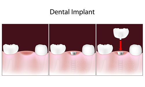 Durham Dental Implants
