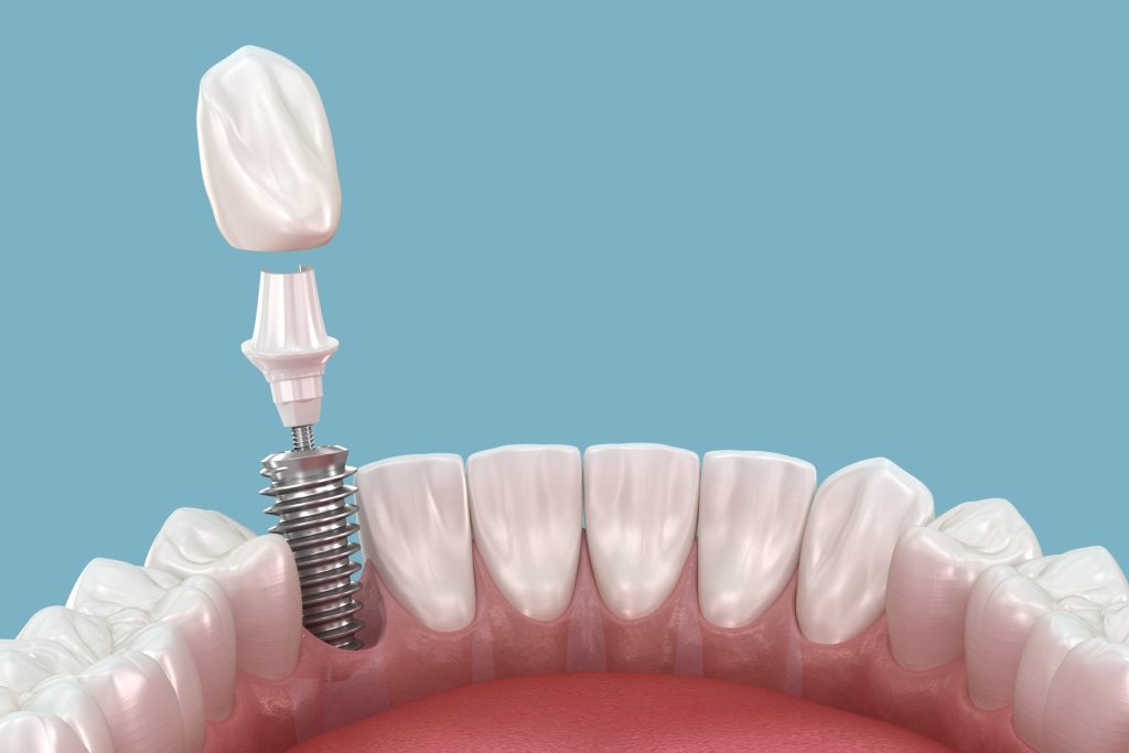 Dental Implants vs. Dentures: Which Tooth Replacement Option Fits Your Lifestyle?