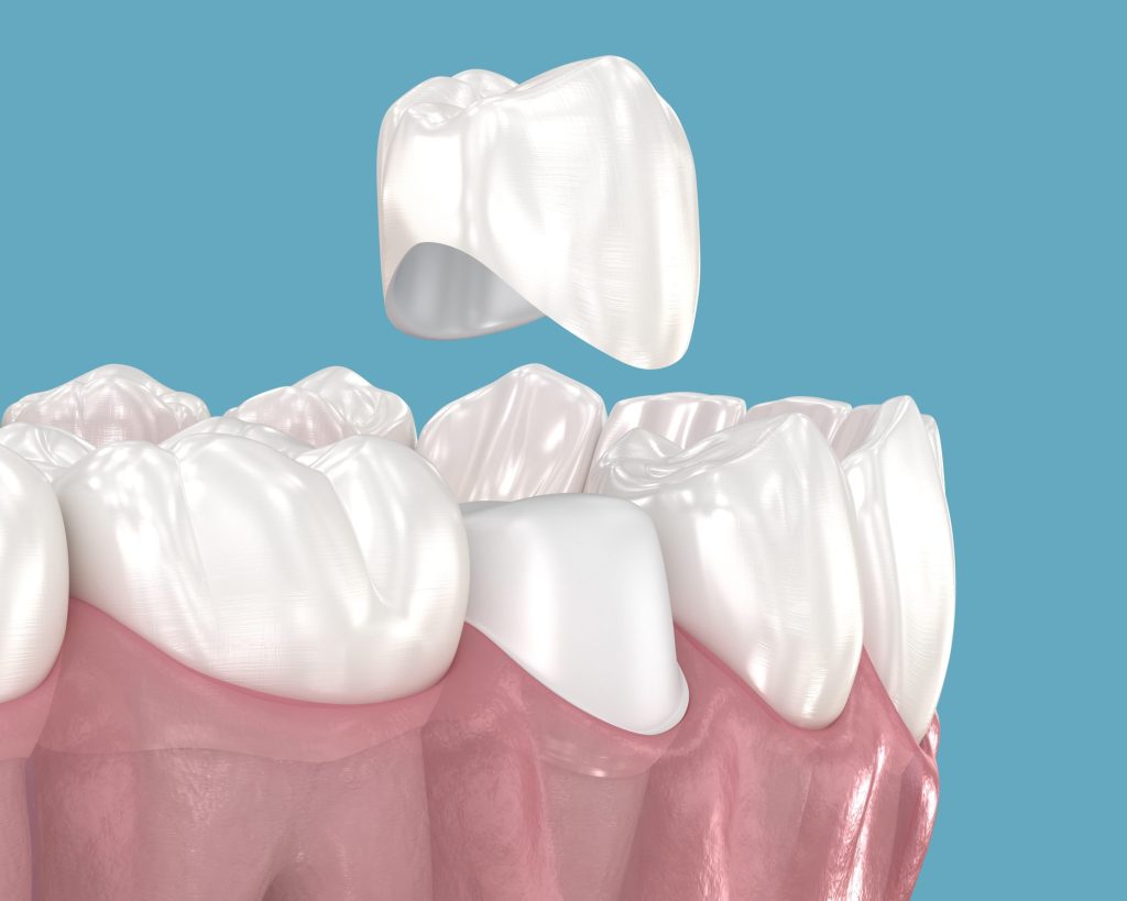 Same-Day CEREC Crowns in Durham: What to Expect