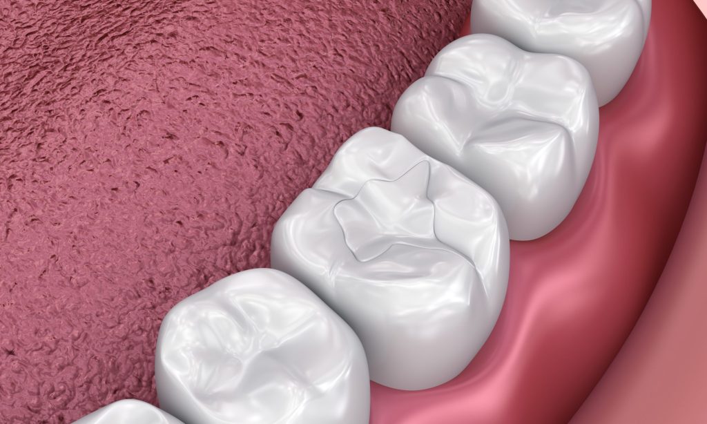 When Dental Fillings Are No Longer Enough: Moving From Temporary to Long-Term Solutions
